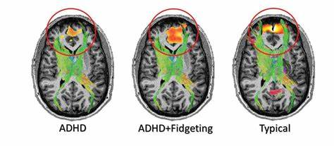 MRI illustrating structural and connectivity differences associated with ADHD